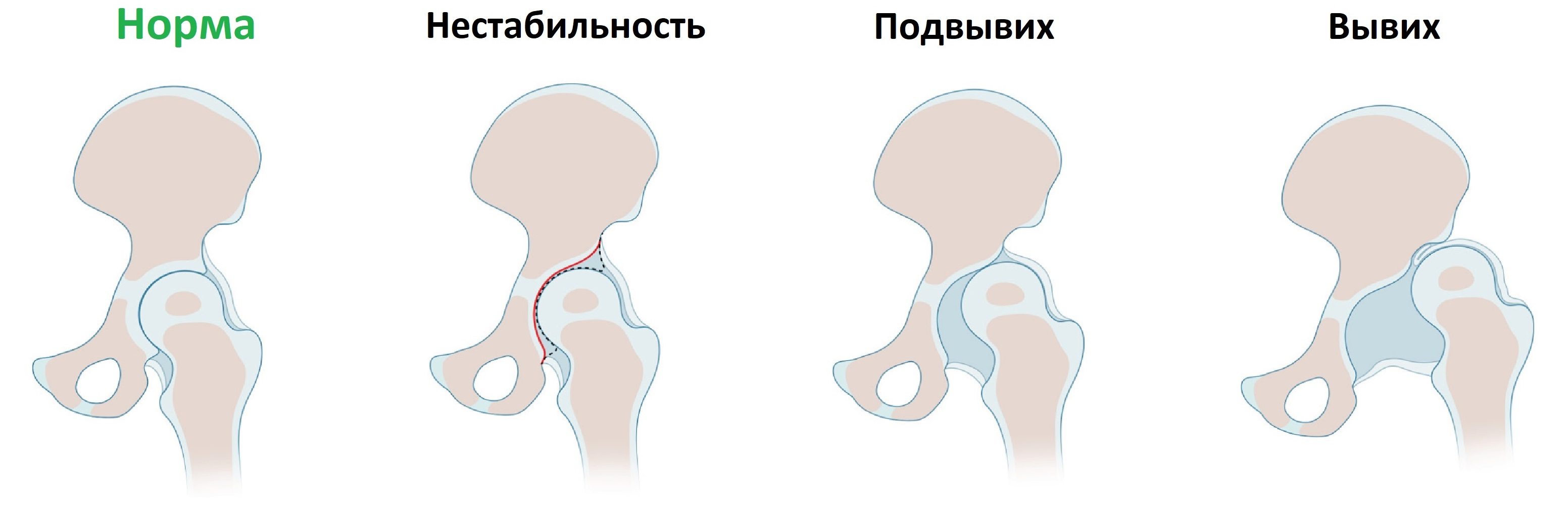 Реферат: Дисплазия тазобедренного сустава