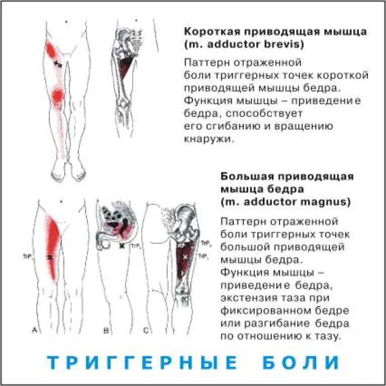 Сильные боли в области бедра. Болит точка на бедре сбоку. Триггерные точки мышц ног. Болит мышца бедра. Приводящие мышцы бедра триггерные точки.