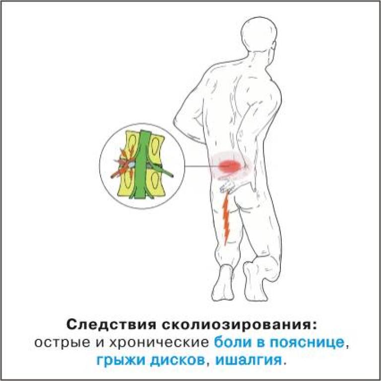 Болит поясница слева у мужчины. Боль в пояснице. Боль в поясничной области. Болит спина. Боли в спине в области.