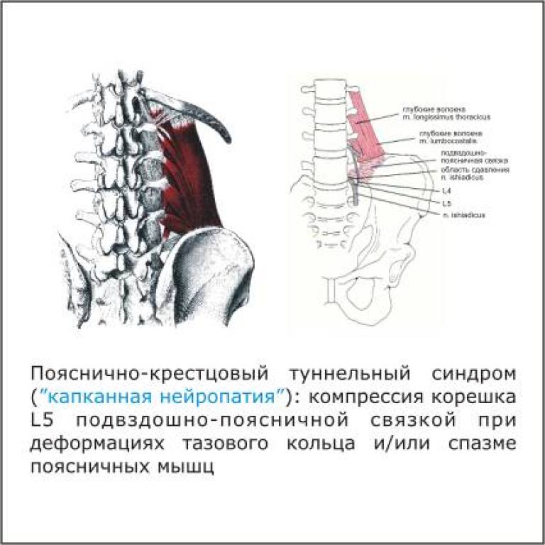 Чем лечить пояснично крестцовый отдел позвоночника