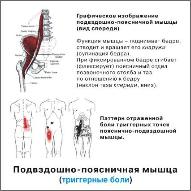 Боль в ягодице и пояснице. Подвздошно-поясничная мышца триггерные точки. Подвздошно-поясничная мышца триггерные боли. Подвздошно поясничная мышца живота функции. Укорочение подвздошно-поясничной мышцы одностороннее.