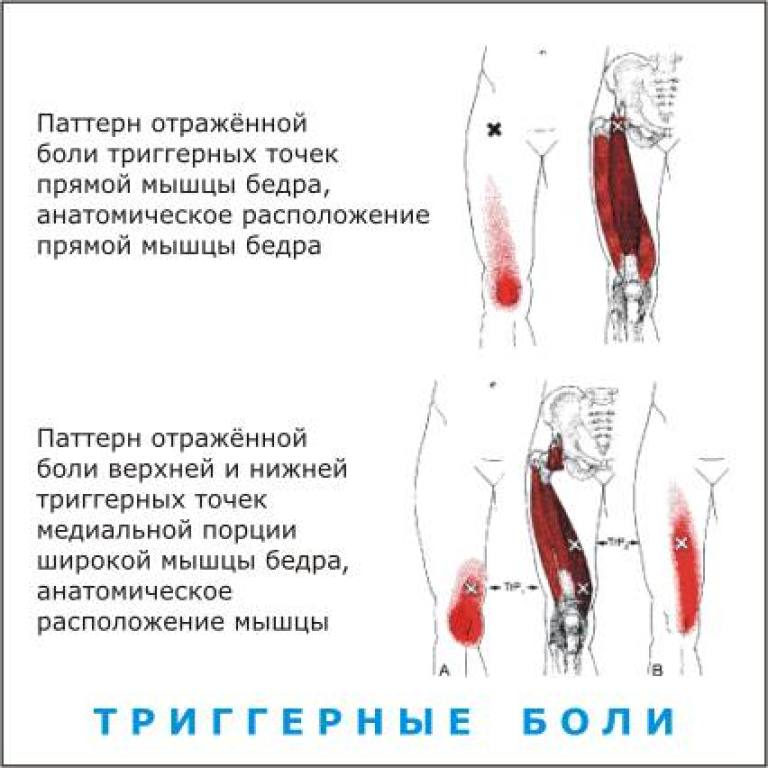 Ляшка жжет. Триггерные точки четырехглавой мышцы бедра. Триггерные точки мышц таза. Триггерные точки тазобедренного сустава и бедра. Триггерные точки ягодичной мышцы.