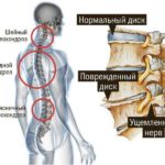 Остеохондроз, клиническая картина