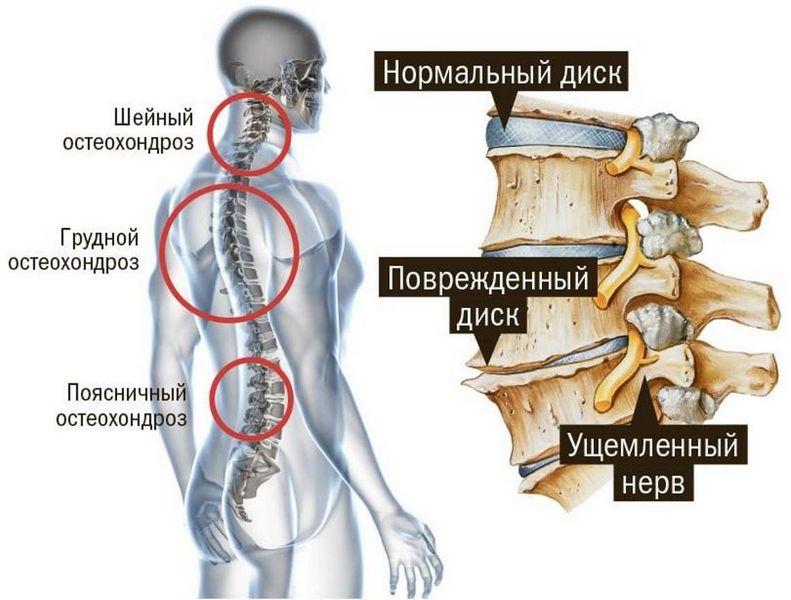 osteohondroz_036