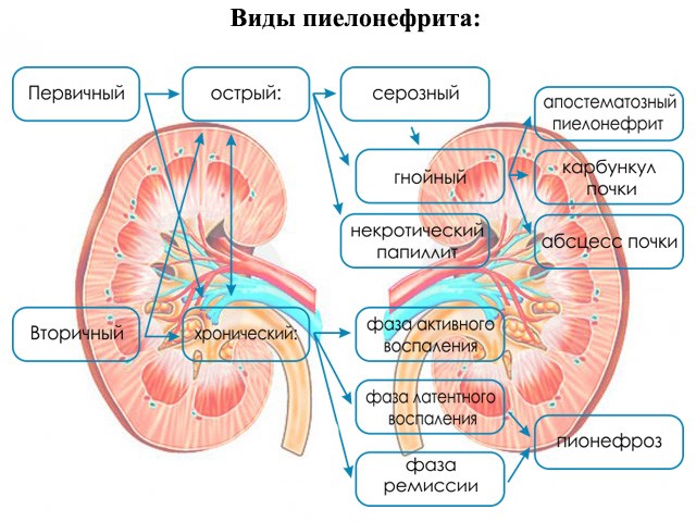 pielonefrit_0003